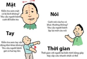 Dấu Hiệu 7 Ngày Trước Khi Bị Đột Quỵ