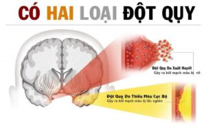 Đột quỵ não – Những điều cần biết