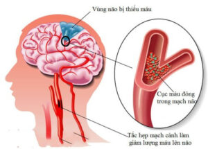 Những Ai Có Nguy Cơ Cao Mắc Bệnh Đột Quỵ